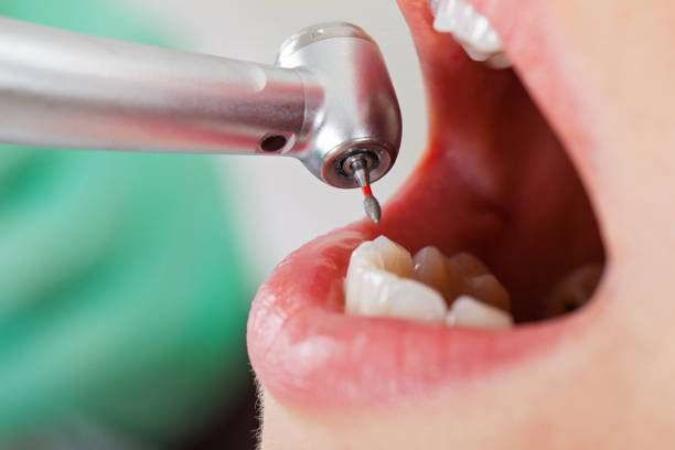 Best Chipped Tooth Repair Near Me  in Brenham, TX